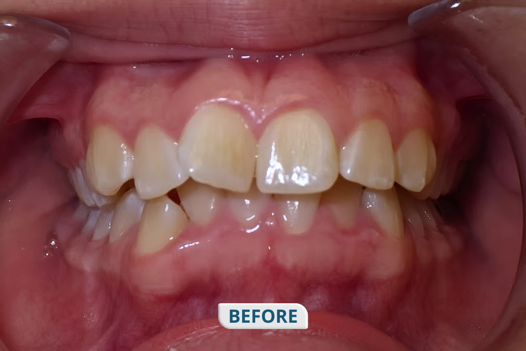 Before Braces Treatment